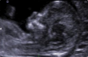 DIAGNÓSTICO AVANZADO DE MALFORMACIÓN FETAL D Mujeres Manizales Colombia